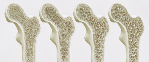 Physio Dublin 15 Bone Health Clonee Phsyio